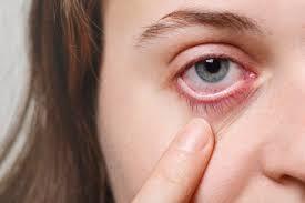 Understanding Pink Eye Symptoms: Causes, Types & Relief photo 1