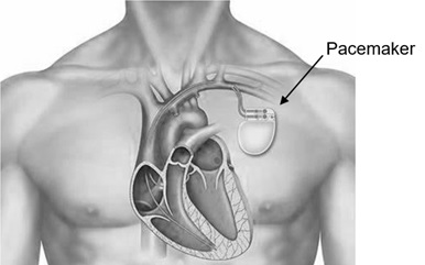 Advanced Heart Pacemaker Surgery In UAE photo 1