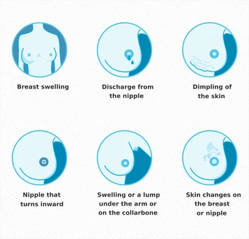 Breast Cancer: Early Signs, Treatment & Prevention Guide