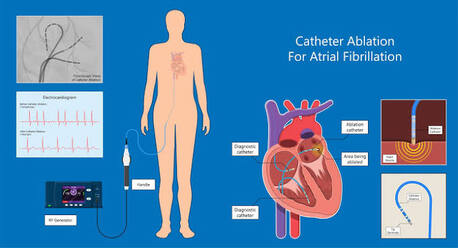 Best Cardiac Care For Atrial Fibrillation Ablation | The Heart.ae photo 1