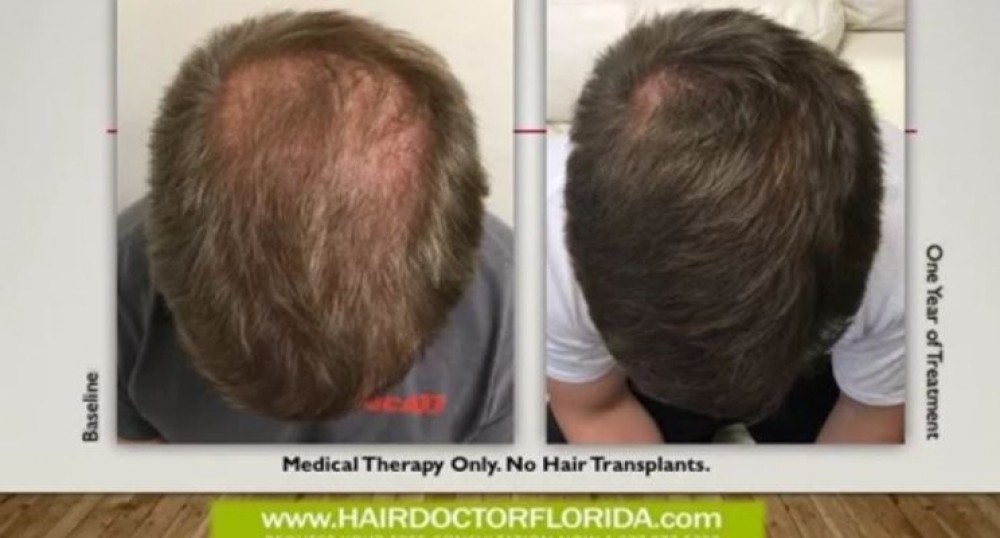 Affordable Hair Transplant in Florida photo 1
